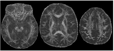 Cognitive Deficits and White Matter Alterations in Highly Trained Scuba Divers